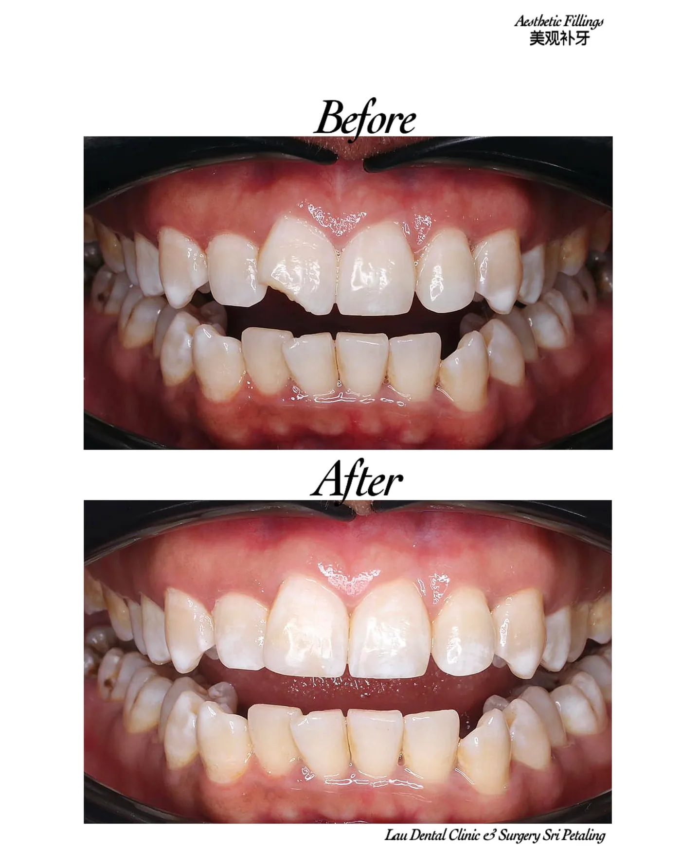 Aesthetic composite fillings before and after, rebuilding chipped and worn upper front teeth into an even, natural-looking edge