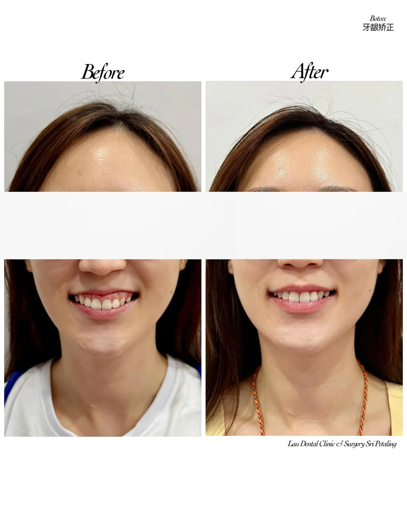 Botox gum correction before and after, softening an excessive gum show so more tooth is visible in a balanced, relaxed smile