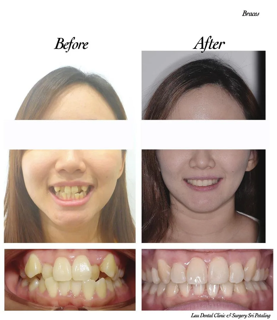 Braces before and after, straightening crowded and overlapping upper front teeth into an even, confident smile