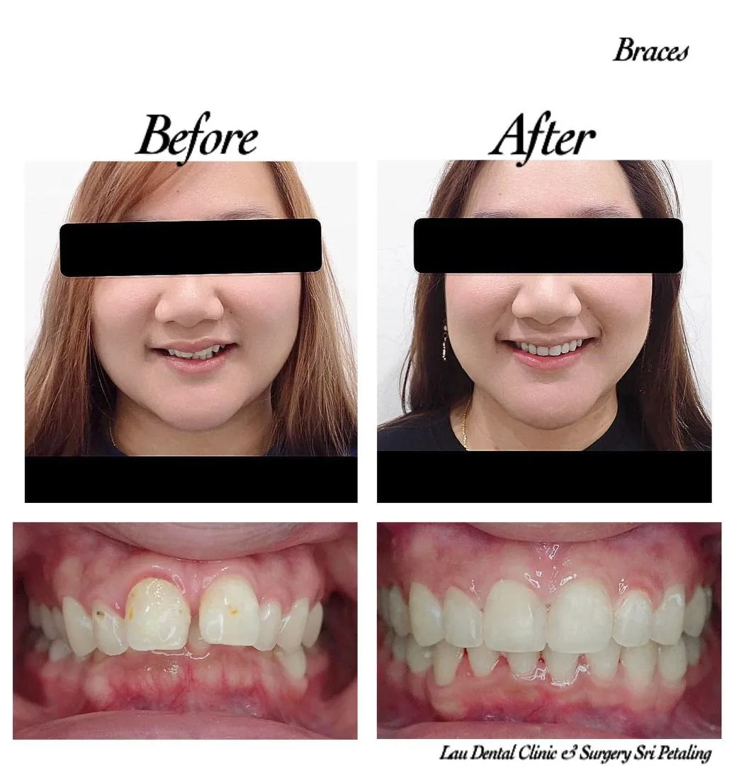 Braces before and after, closing gaps and aligning discoloured front teeth into a neat, even and healthier-looking smile