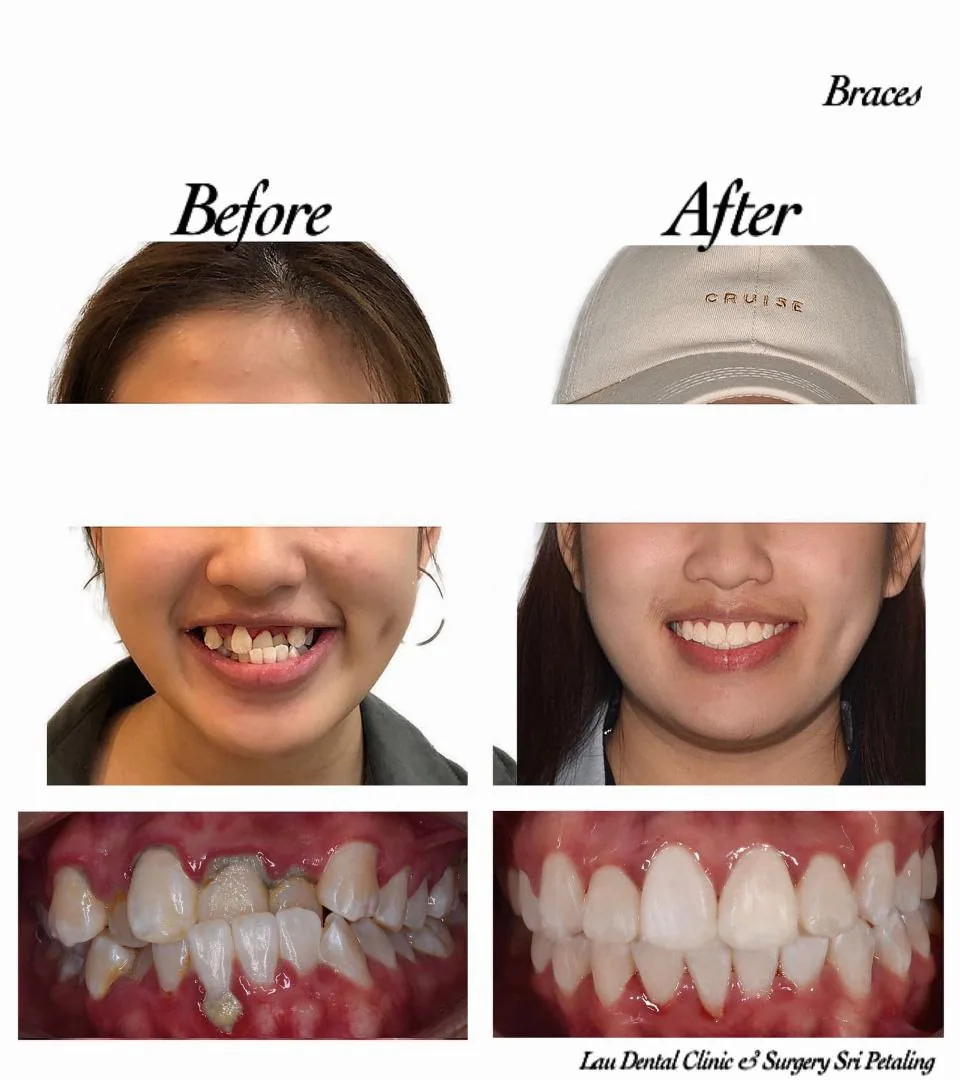 Braces before and after, straightening severely overlapping upper teeth and improving the gum line for a fuller smile