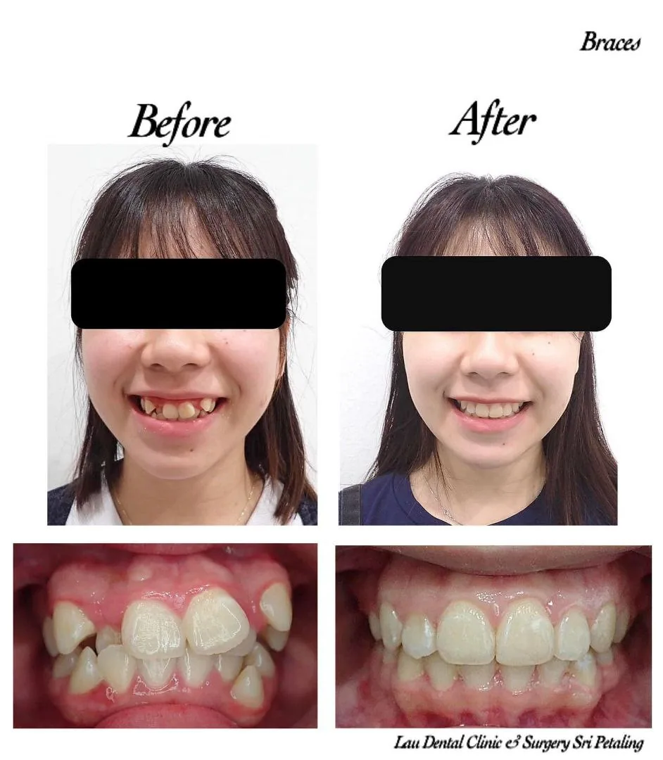 Braces before and after, correcting protruding and rotated front teeth for a straighter smile and improved bite