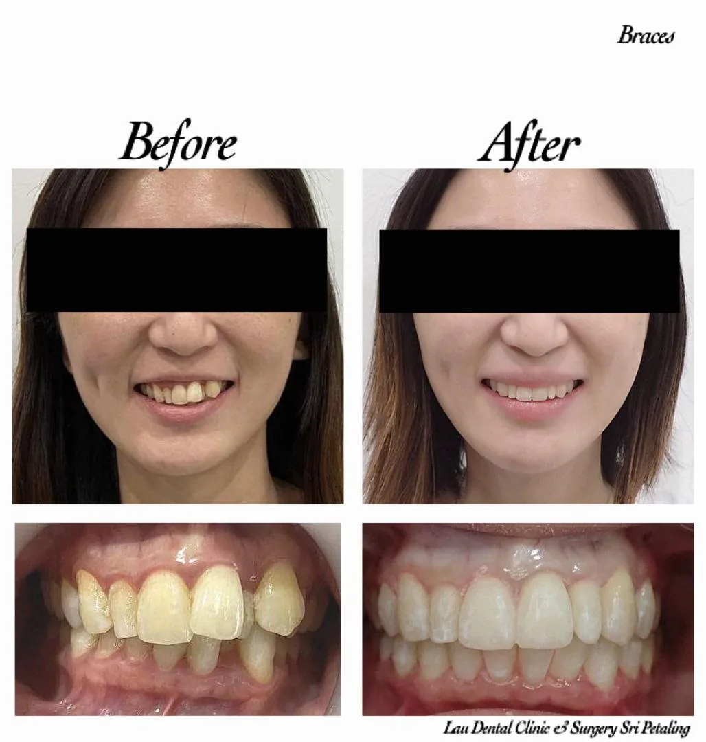 Braces before and after, levelling uneven upper front teeth and closing the bite for a balanced, natural-looking smile