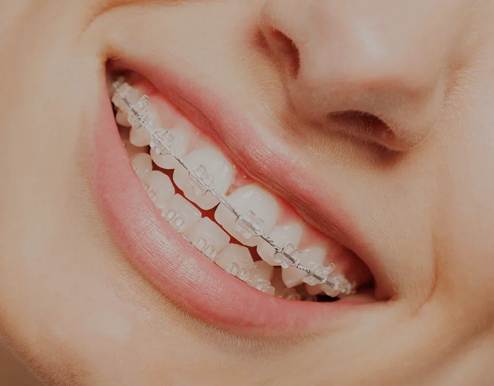Tooth-coloured ceramic self-ligating braces on a smiling patient, a discreet way to straighten teeth for adults and older teens