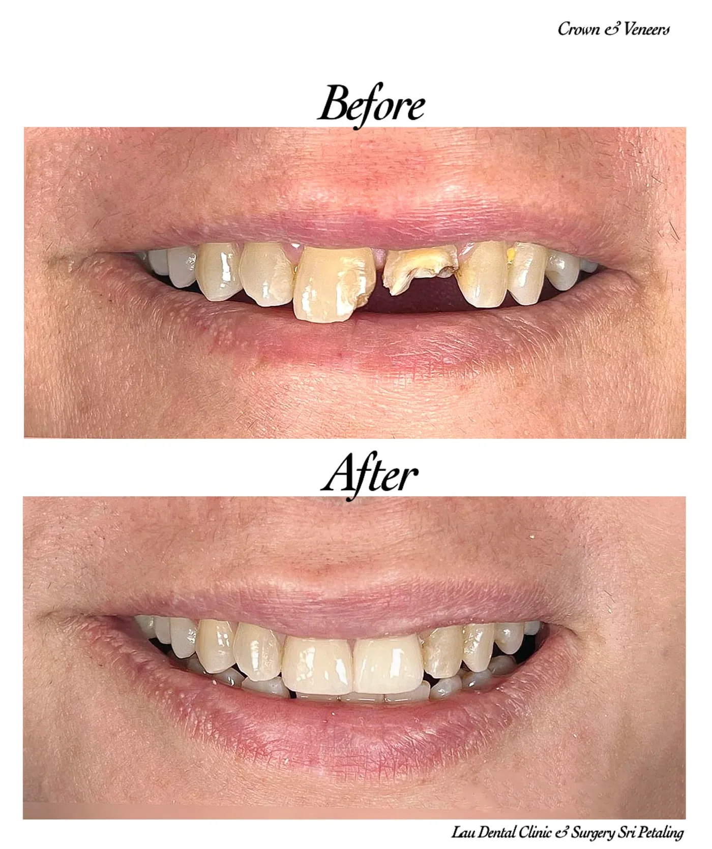 Crowns and veneers before and after, restoring a broken and missing upper tooth for improved dental function and confidence