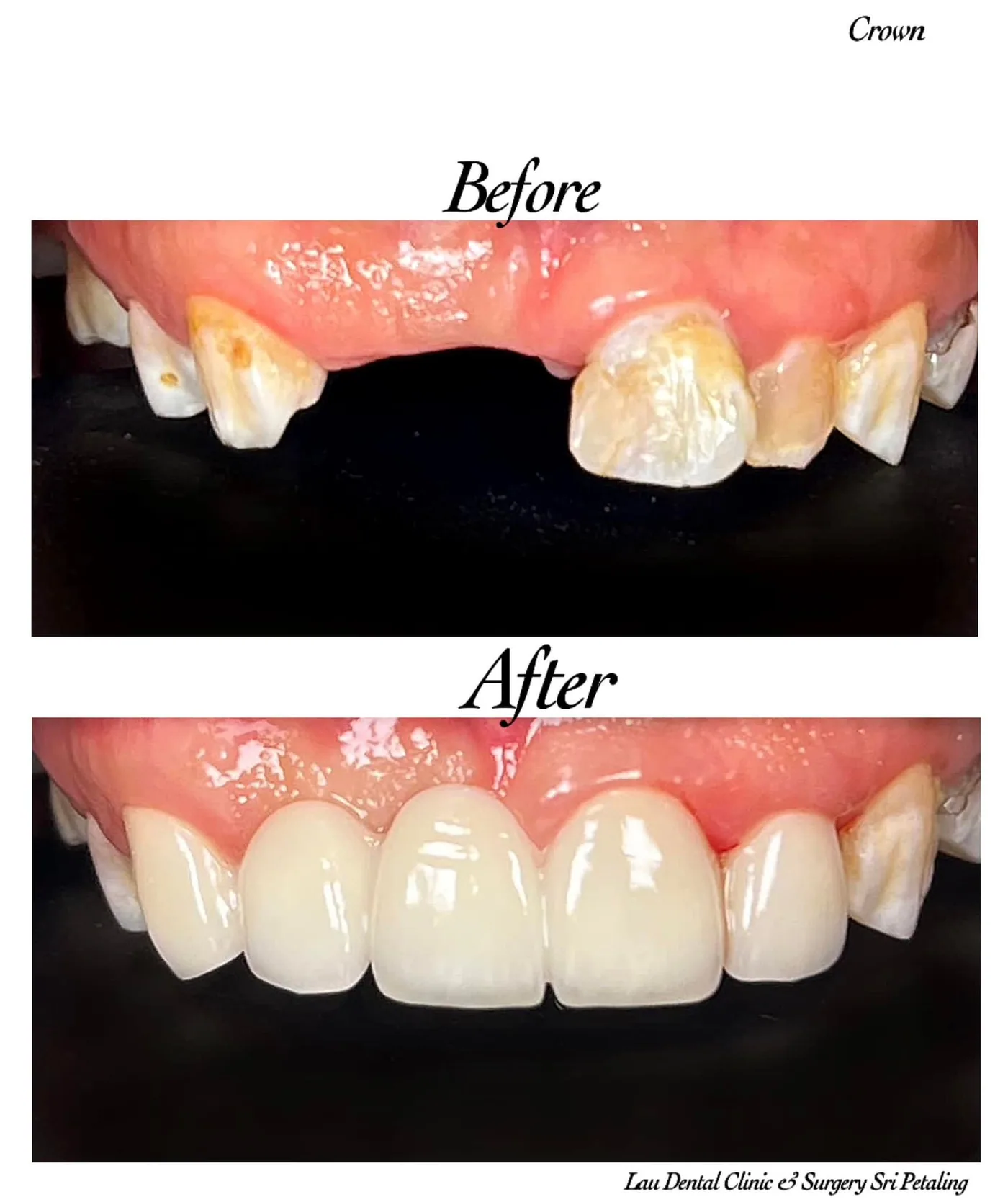 Dental crowns before and after, replacing broken and decayed upper front teeth with a bright, natural-looking restoration