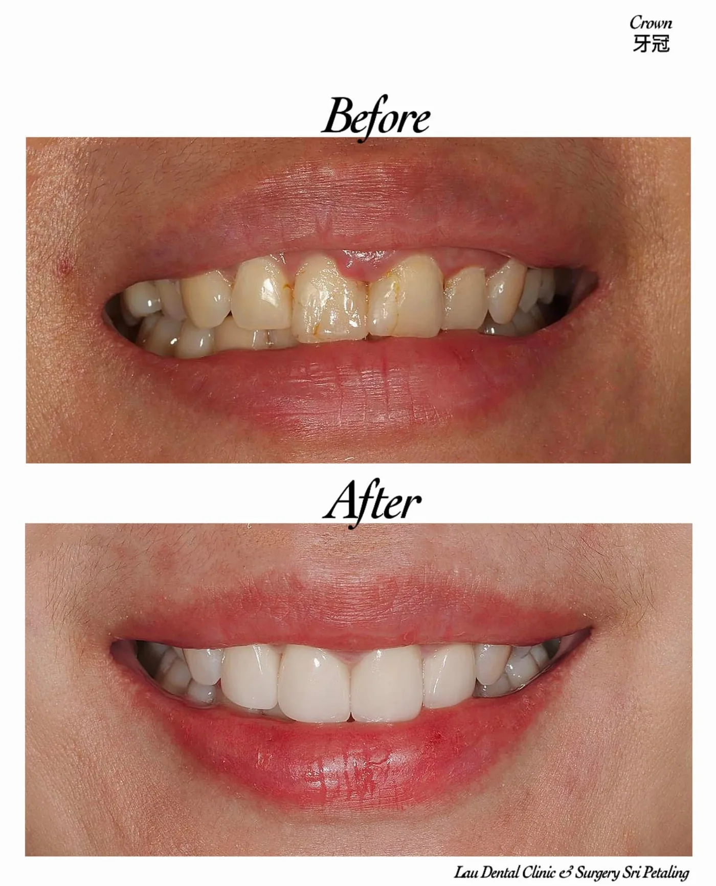 Dental crowns before and after, restoring worn and discoloured upper front teeth with strong, natural-looking porcelain restorations