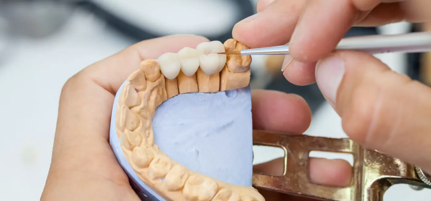 Technician fitting a crown and bridge on a dental model, custom made to match the shade and shape of your own teeth