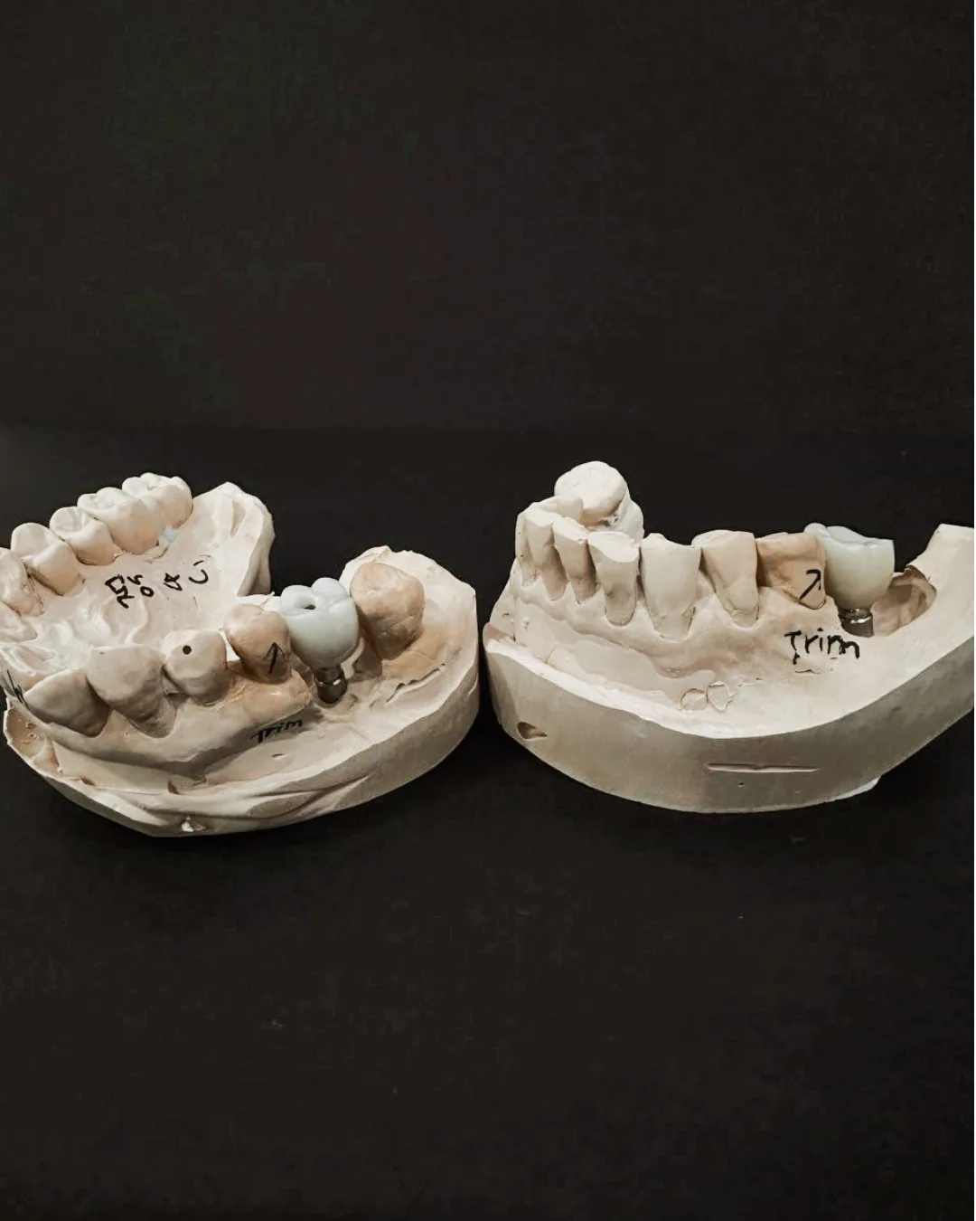 Dental study models with implant analogues in place, used to plan exactly where a new tooth will sit before surgery