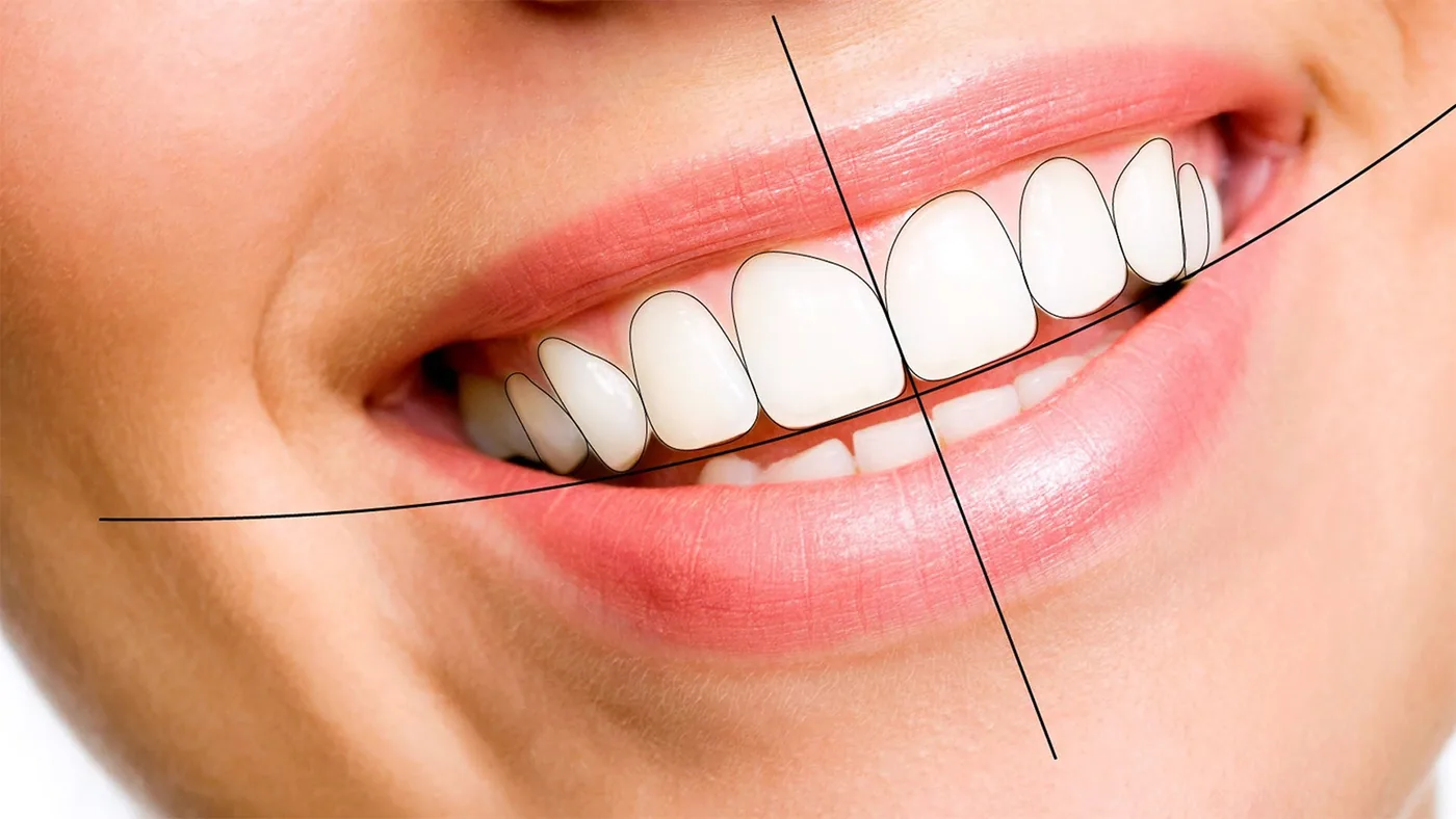 Smile with veneers overlaid with digital smile design proportion guides, showing how tooth width and midline are planned