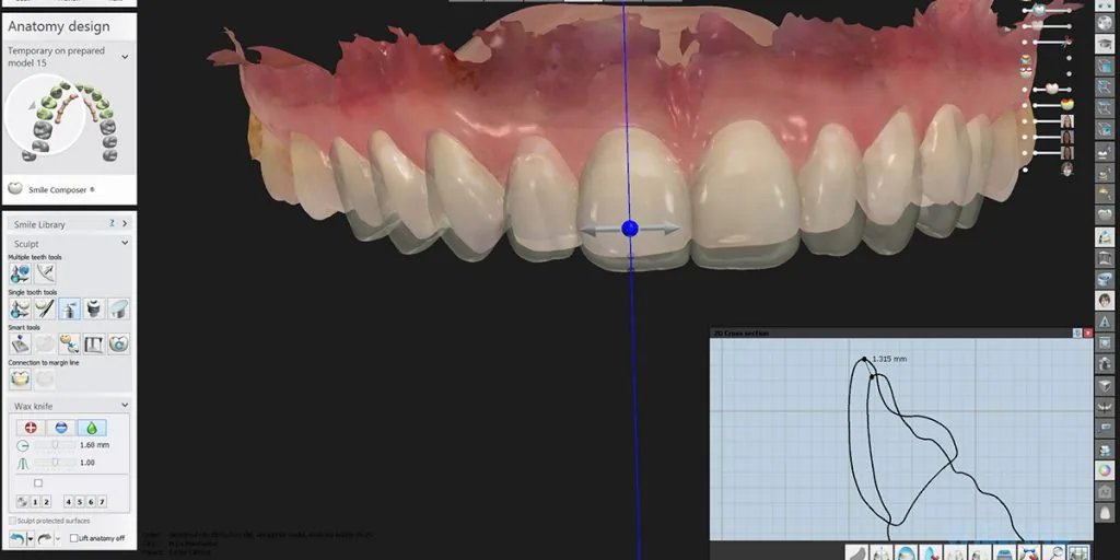 Digital smile design software mapping a new set of front teeth over the patient scan, planning veneer shape and length before treatment