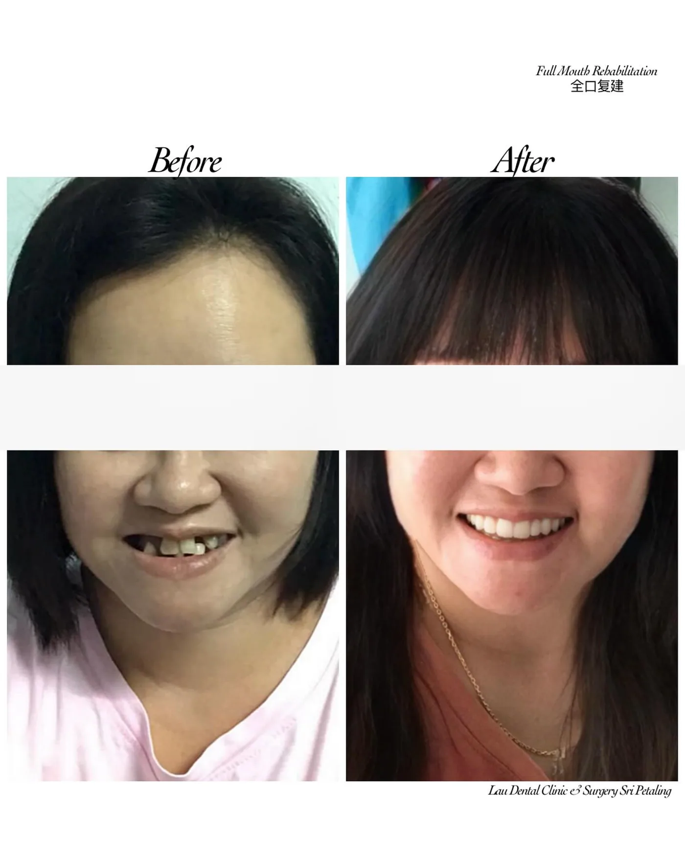 Full mouth rehabilitation before and after: missing and worn upper teeth replaced with a complete, natural-looking smile