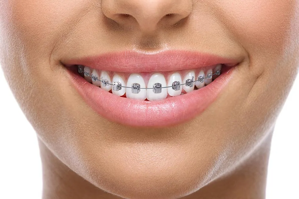 Genius self-ligating metal braces on the upper and lower teeth, designed to straighten teeth comfortably with fewer adjustment visits