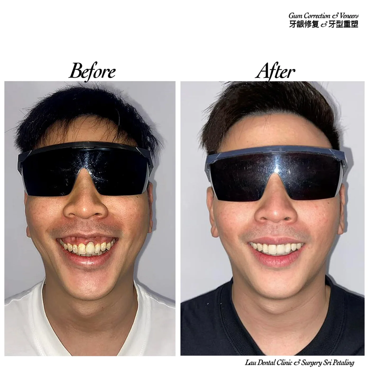 Gum correction with veneers before and after, reshaping an uneven gum line into a balanced, even smile with brighter front teeth