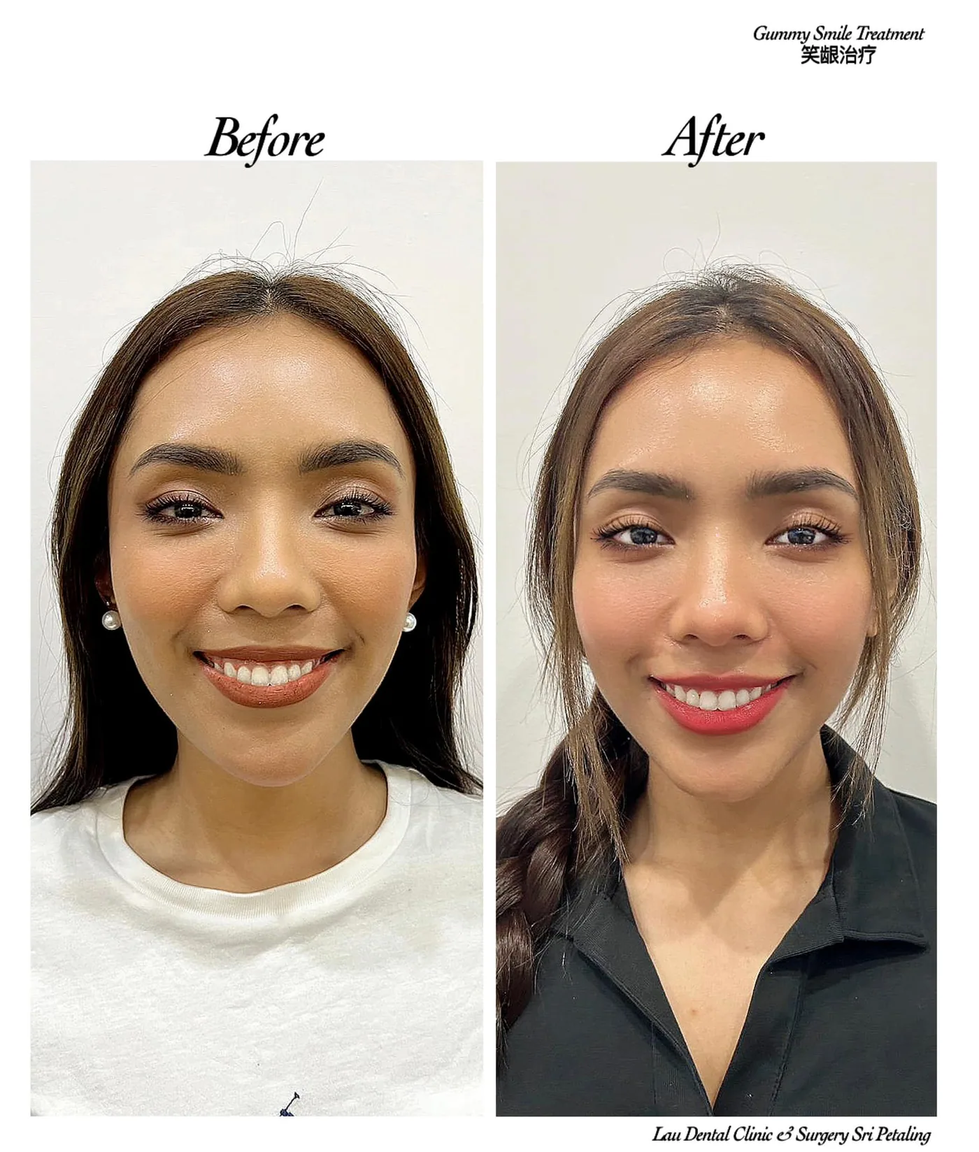 Gummy smile treatment before and after, reducing how much gum shows when smiling for a balanced, more confident smile line