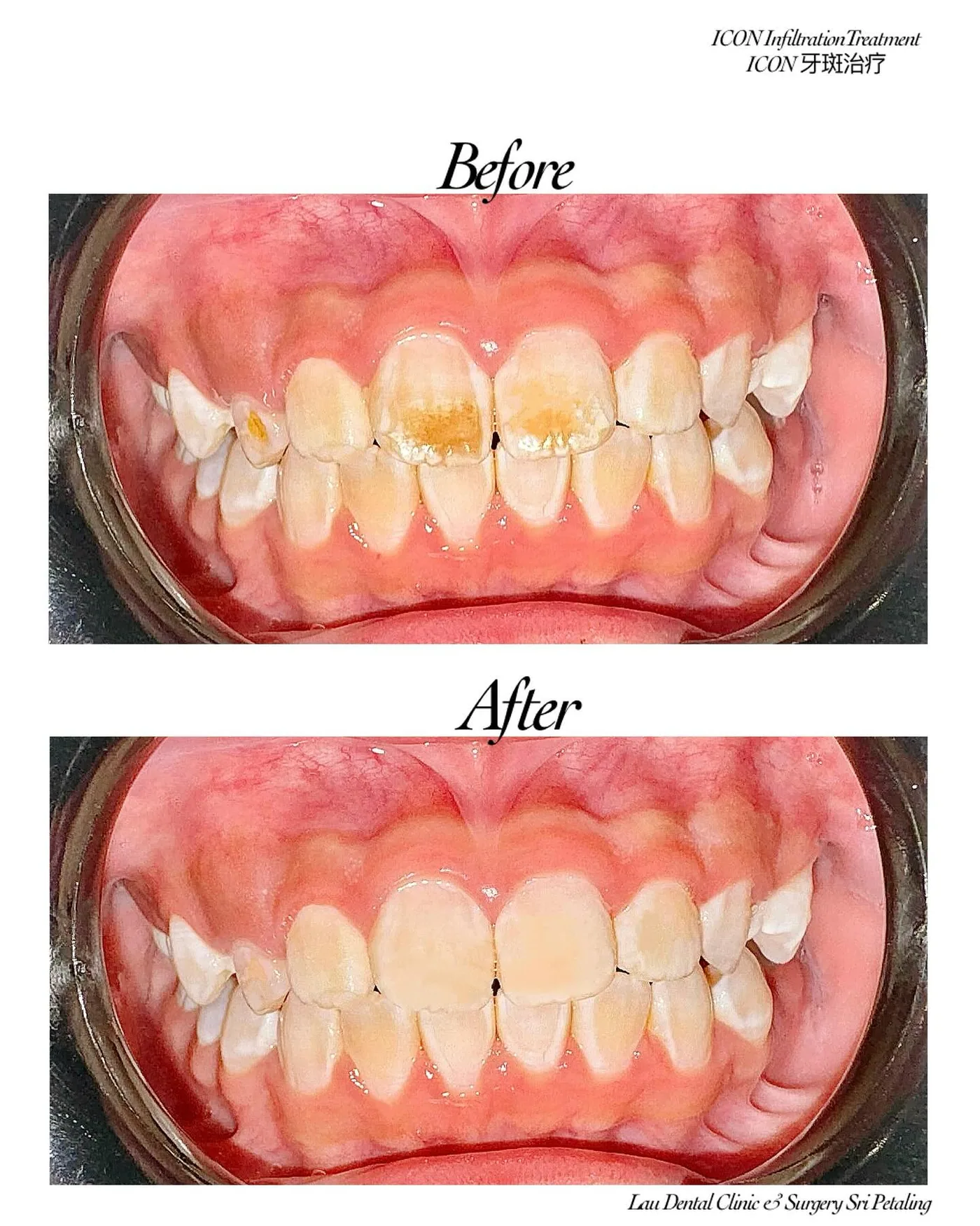 ICON resin infiltration before and after, removing brown and white stain patches from front teeth without drilling tooth structure