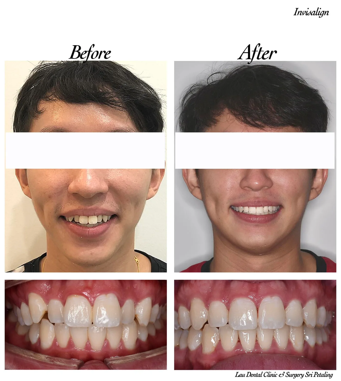 Invisalign before and after, correcting a crossbite and uneven front teeth to give a balanced bite and confident smile