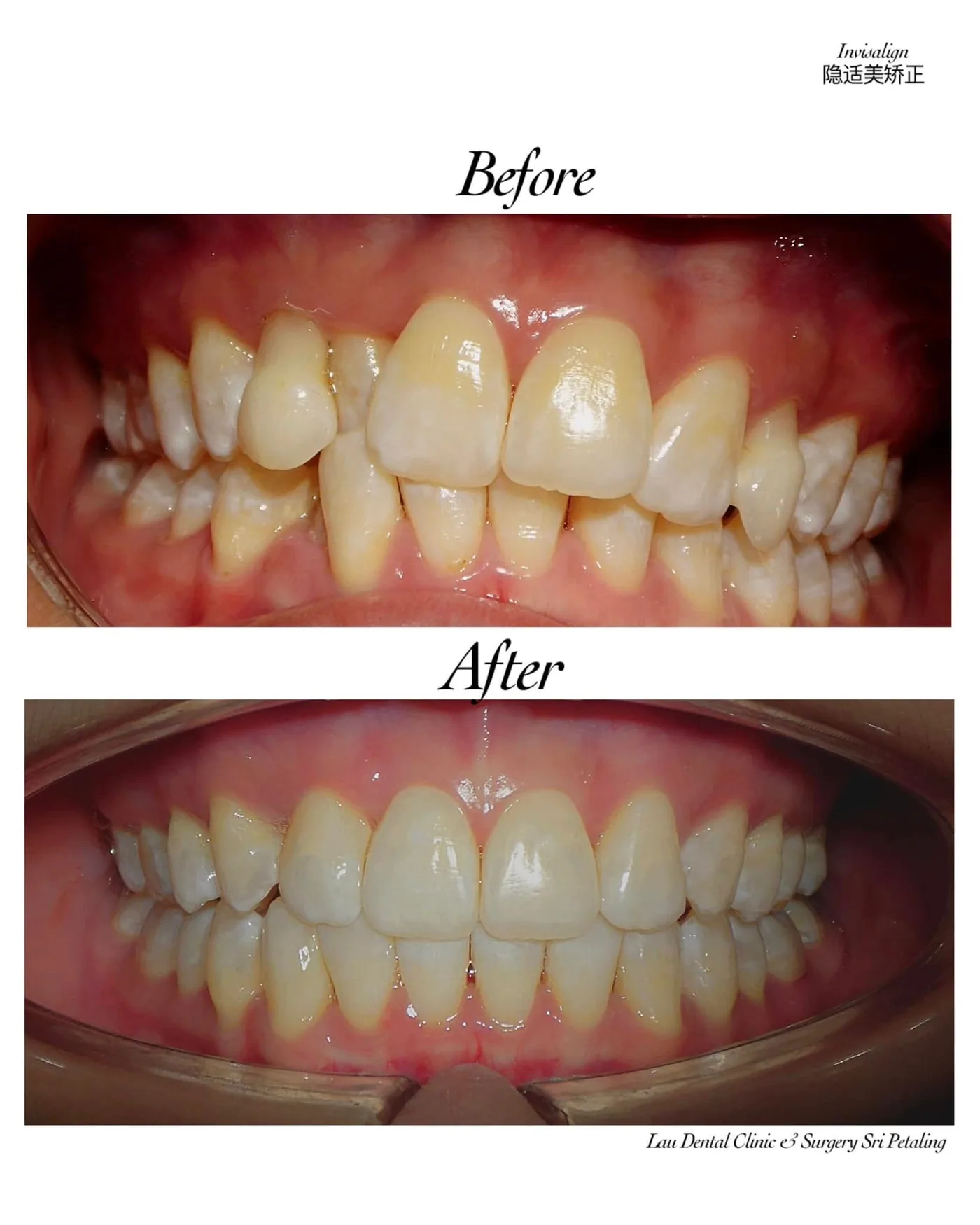 Invisalign before and after, straightening badly crowded and rotated teeth into a neatly aligned, easier-to-clean arch