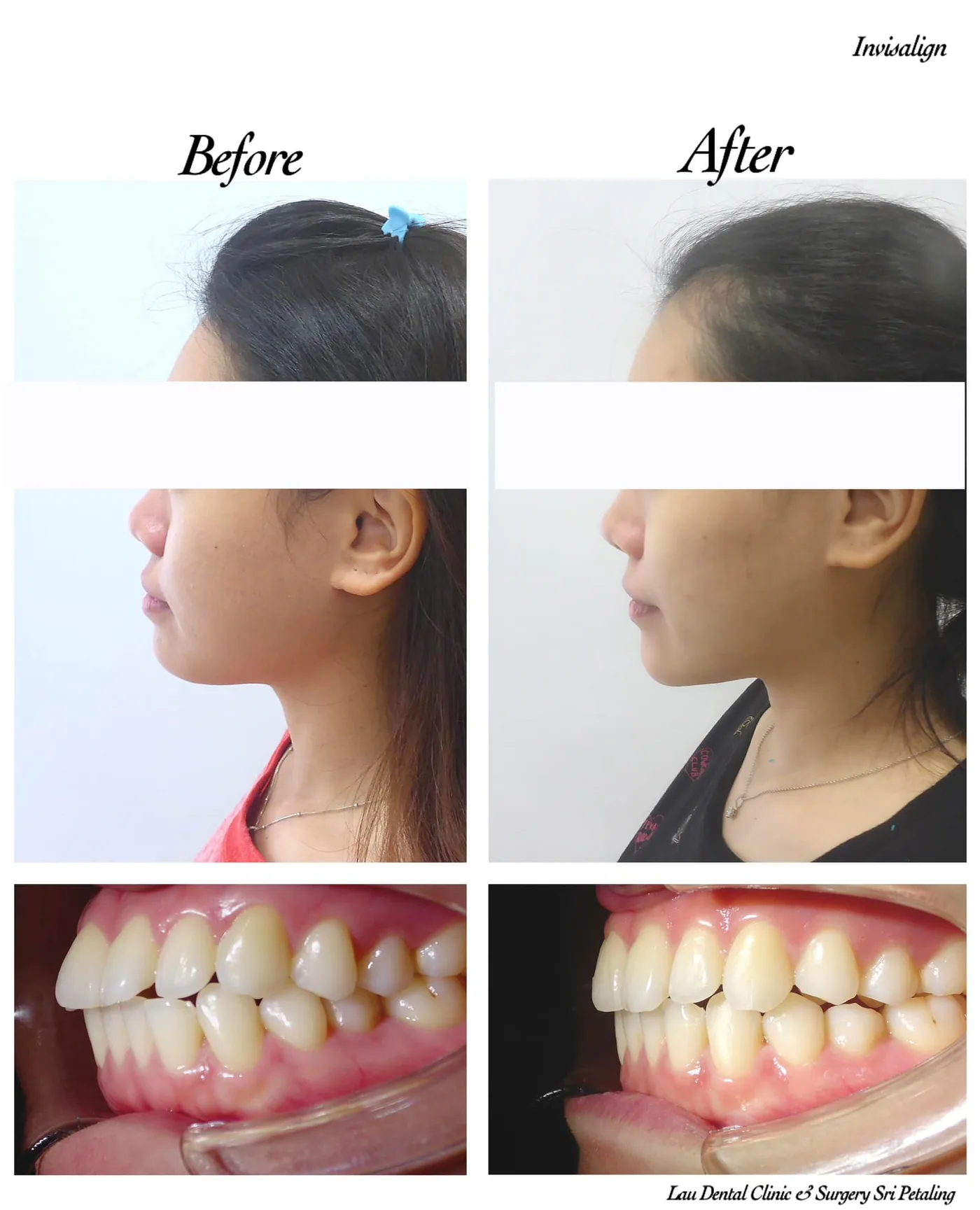 Invisalign before and after side view, showing improved lip profile and bite once protruding teeth were aligned