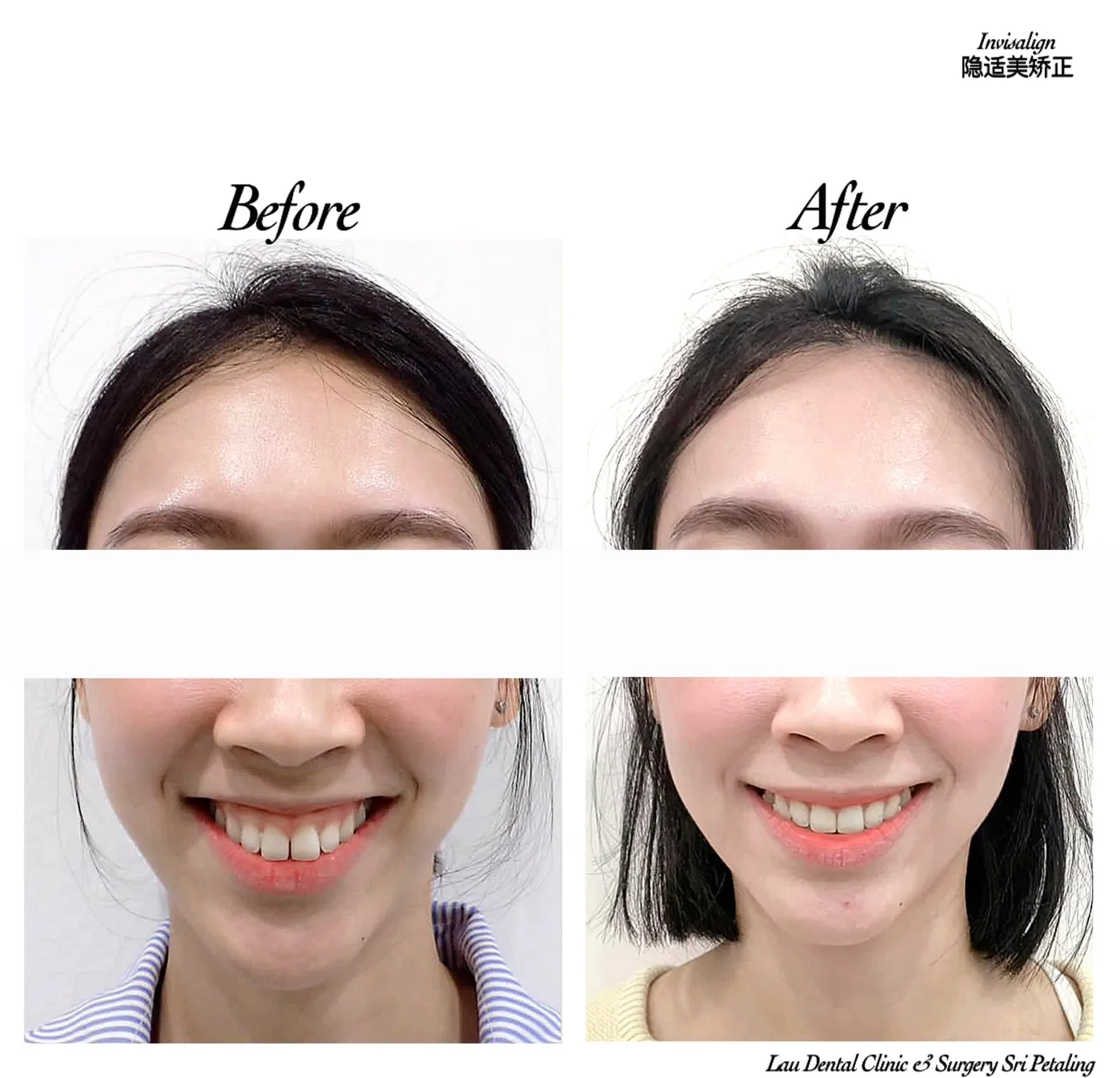 Invisalign before and after, drawing protruding upper front teeth into line for a straighter smile without visible braces