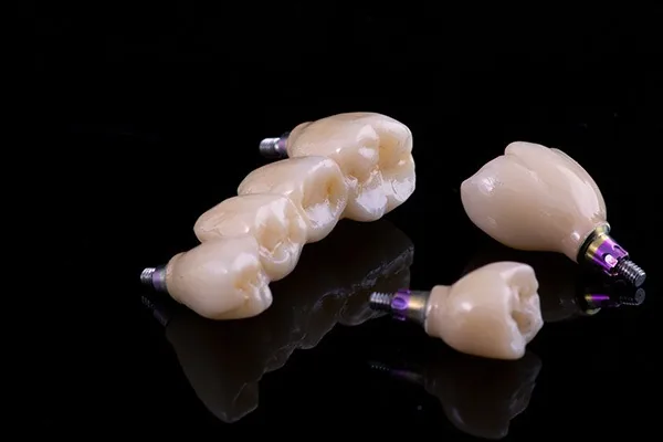 Implant-supported bridge and crown replacing several missing teeth, restoring chewing function without a removable denture