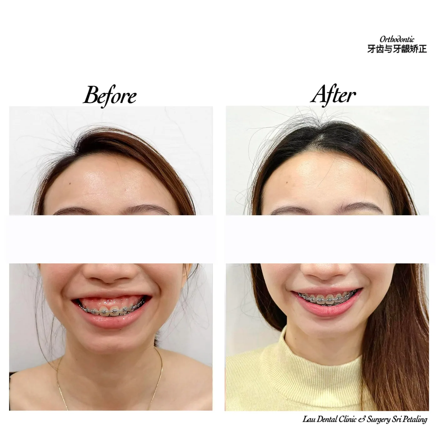 Braces treatment progress before and after, levelling the front teeth and improving the gum line for a more even smile