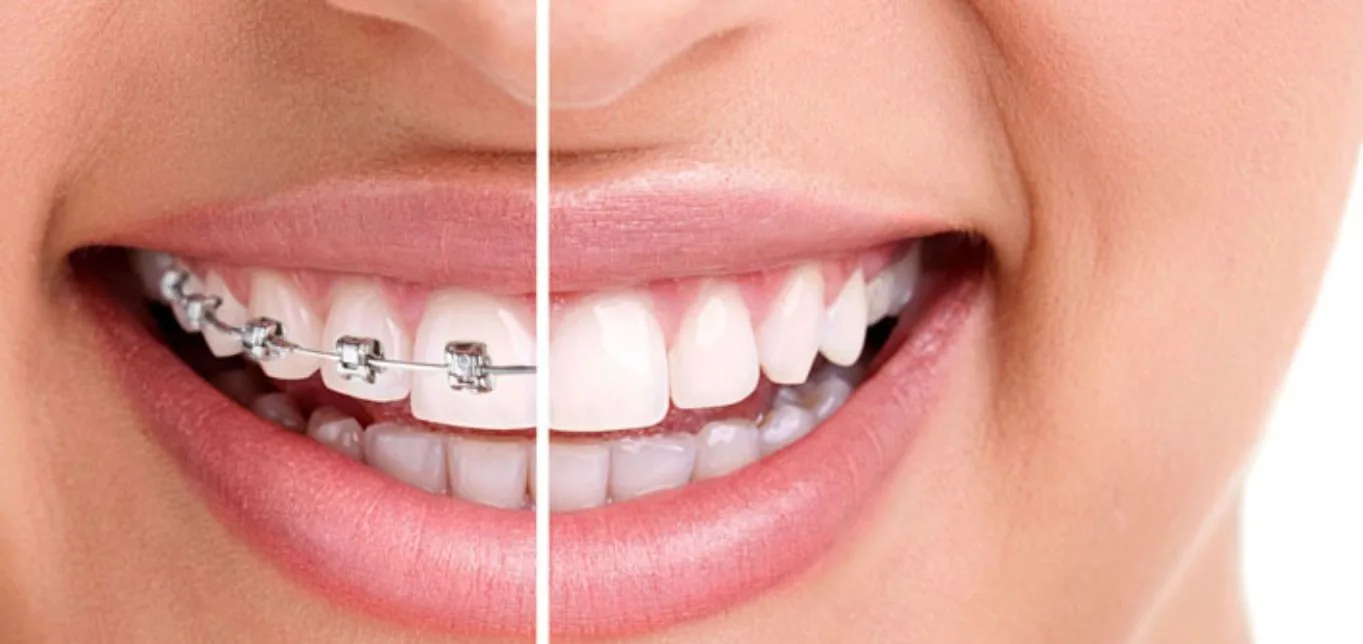 Smile shown half in braces and half after orthodontic treatment, comparing crooked teeth with the straight result
