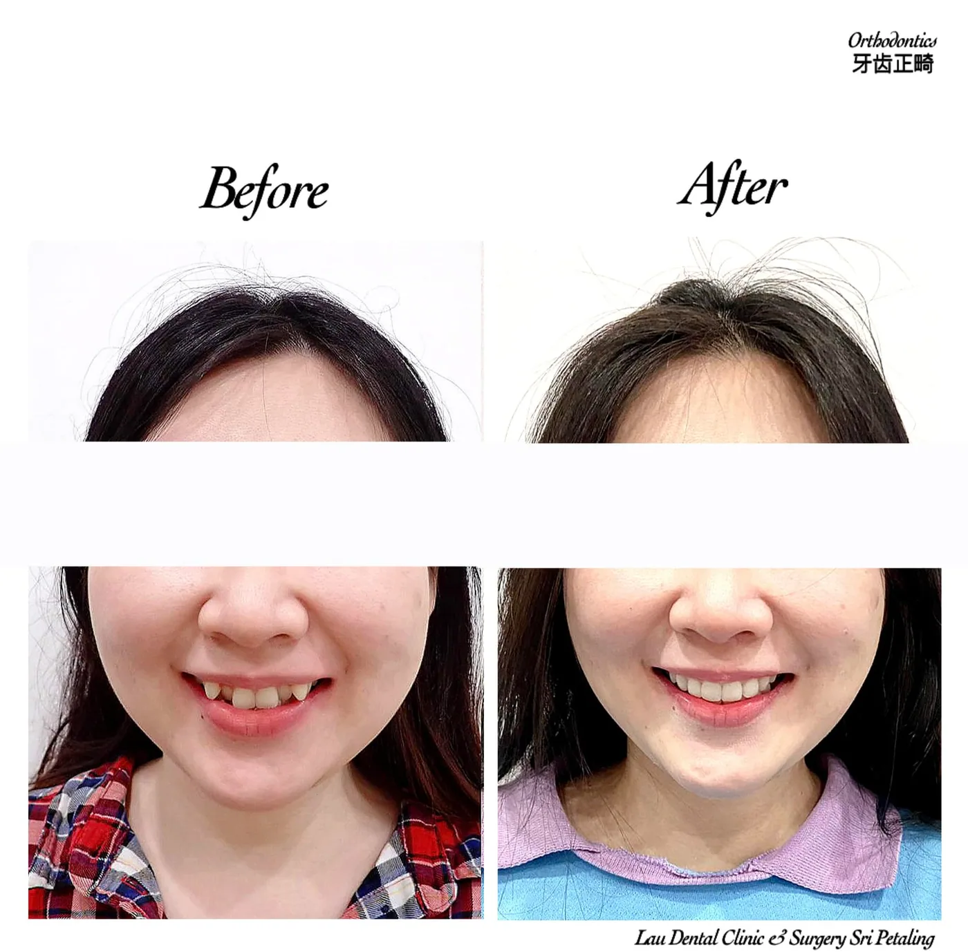 Orthodontic treatment before and after, straightening crooked, overlapping front teeth into an even and confident smile