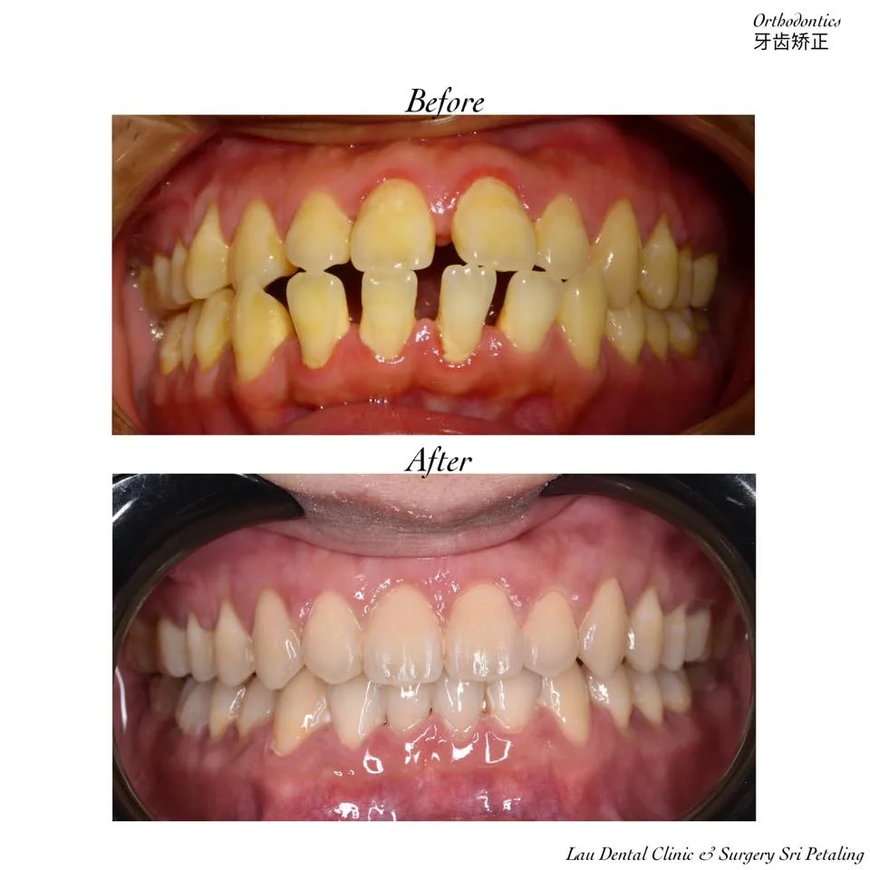 Orthodontic treatment before and after, resolving severe crowding and gaps to give healthy, evenly spaced upper and lower teeth