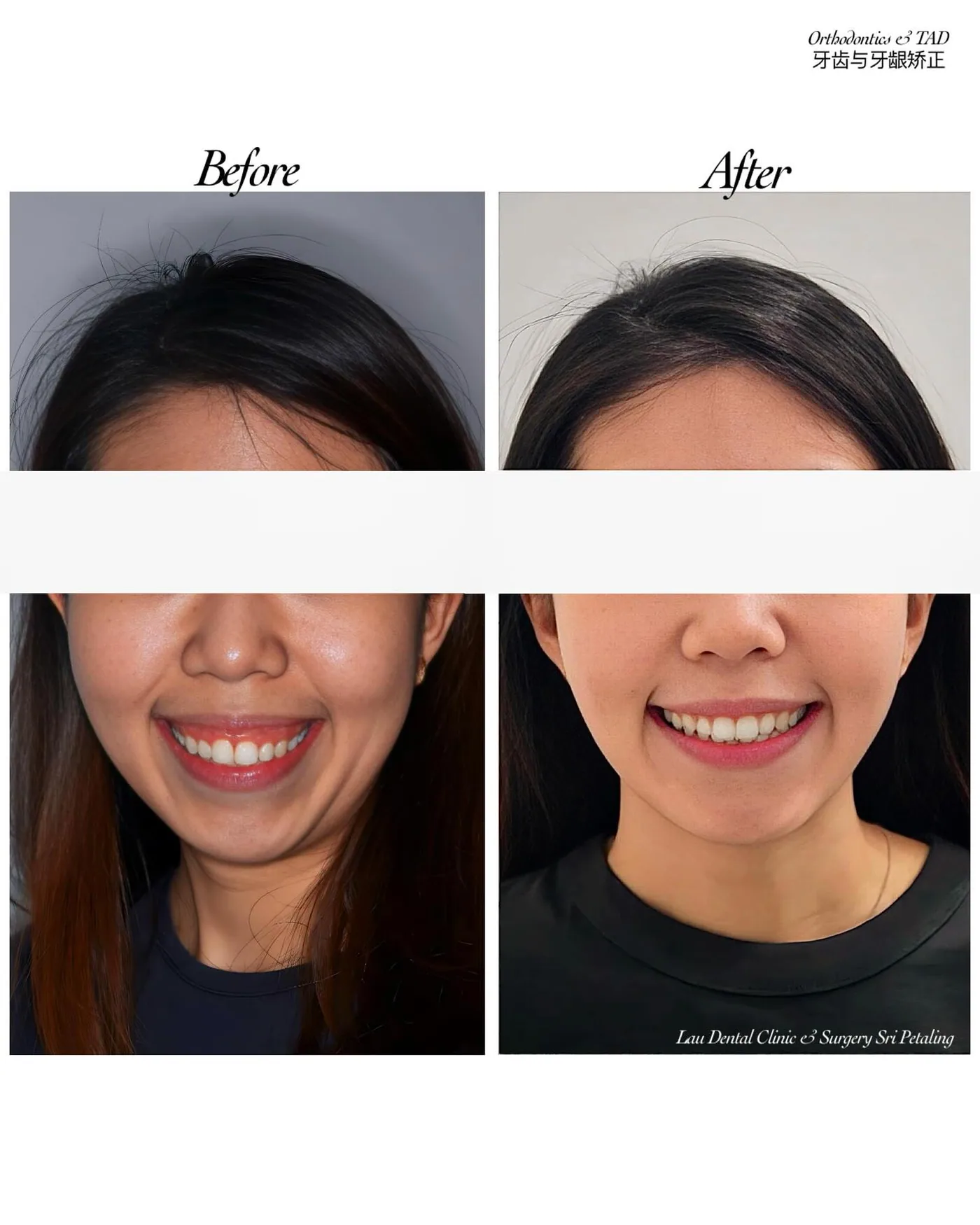 Orthodontic treatment with TADs before and after, correcting protruding upper front teeth into a straighter, more confident smile