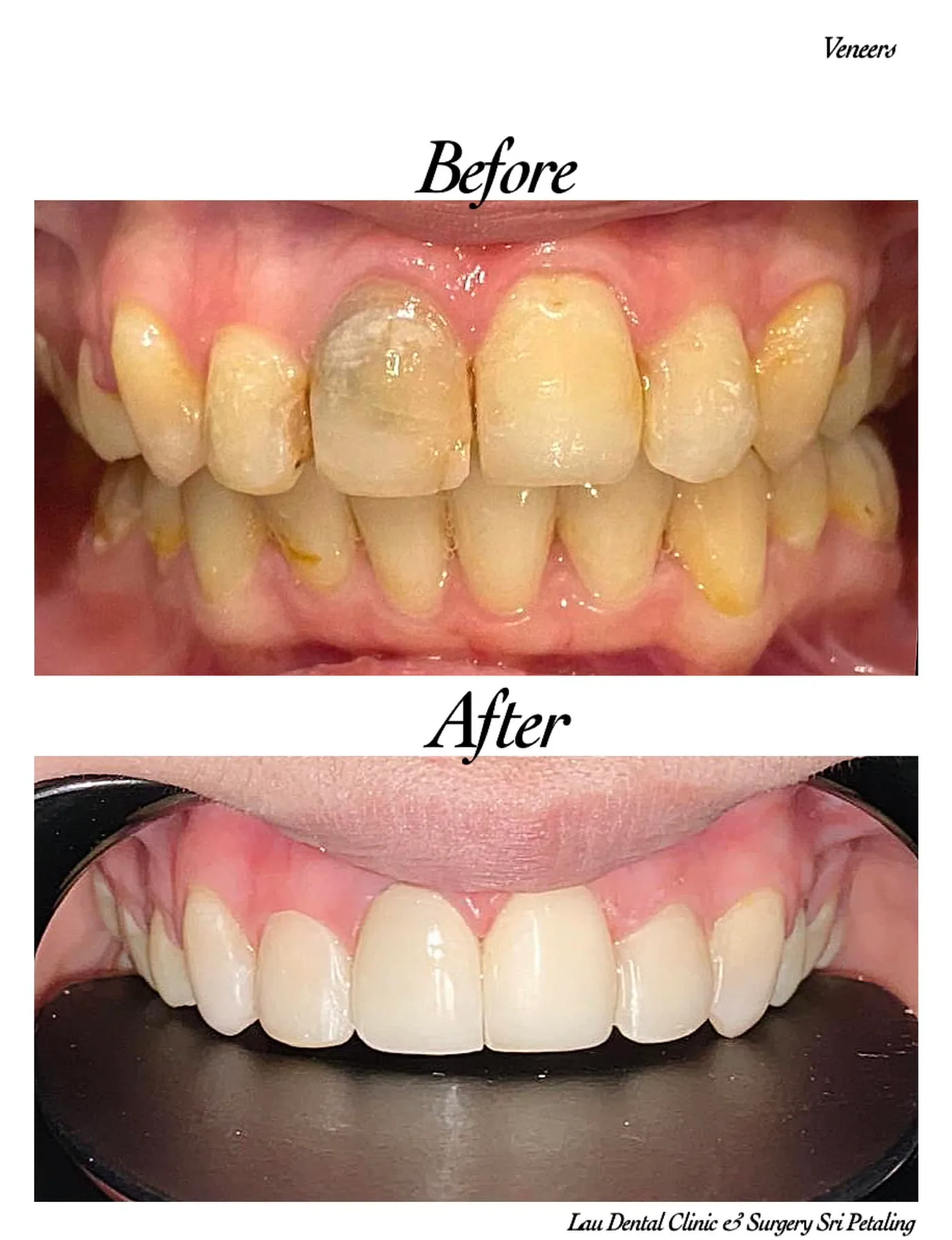 Porcelain veneers before and after, replacing a dark discoloured front tooth and stained neighbours with a bright, natural-looking smile