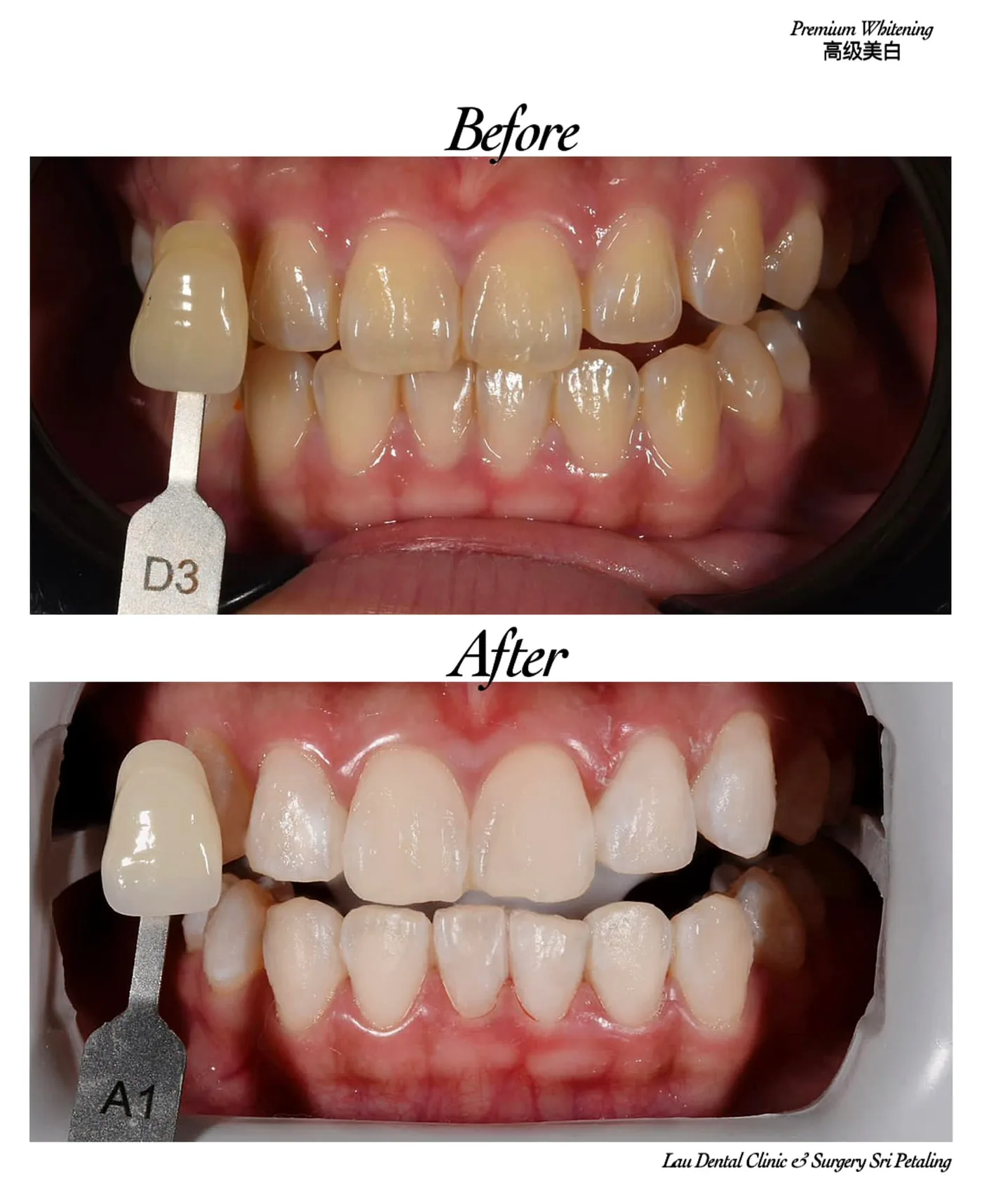 Premium teeth whitening before and after, moving darker D3 teeth to a natural A1 shade for improved smile aesthetics
