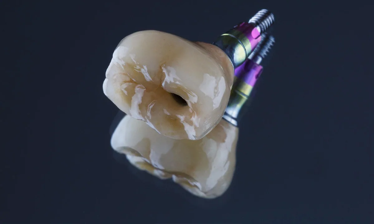Single dental implant fitted with a custom crown, replacing one missing tooth without touching the healthy teeth beside it