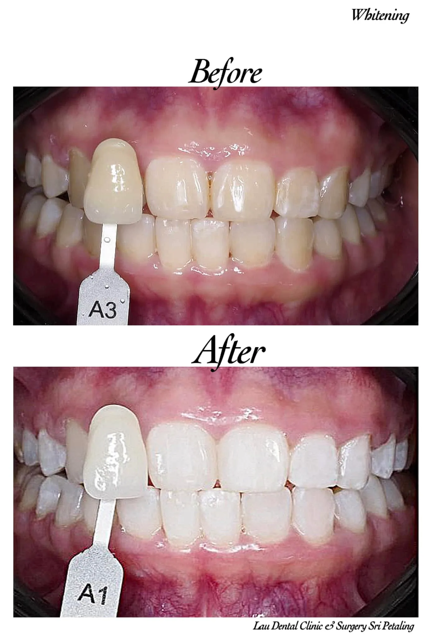 Teeth whitening before and after, brightening mildly yellowed A3 teeth to a clean A1 shade for enhanced smile confidence