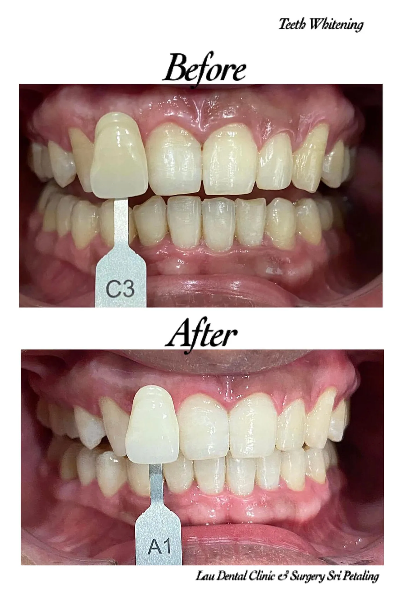 Teeth whitening before and after, lifting the shade from C3 to A1 for a visibly brighter and fresher-looking smile