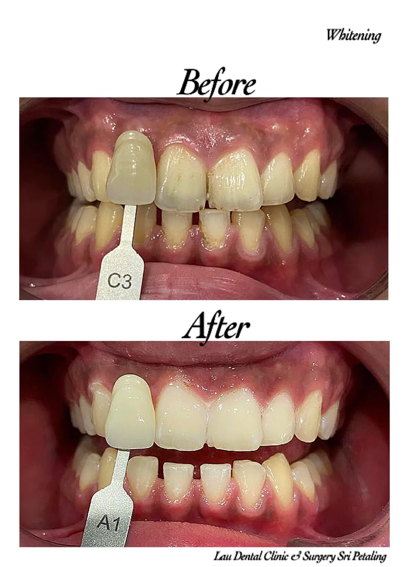Teeth whitening before and after on stained and uneven teeth, brightening the shade from C3 to A1 in a single treatment course