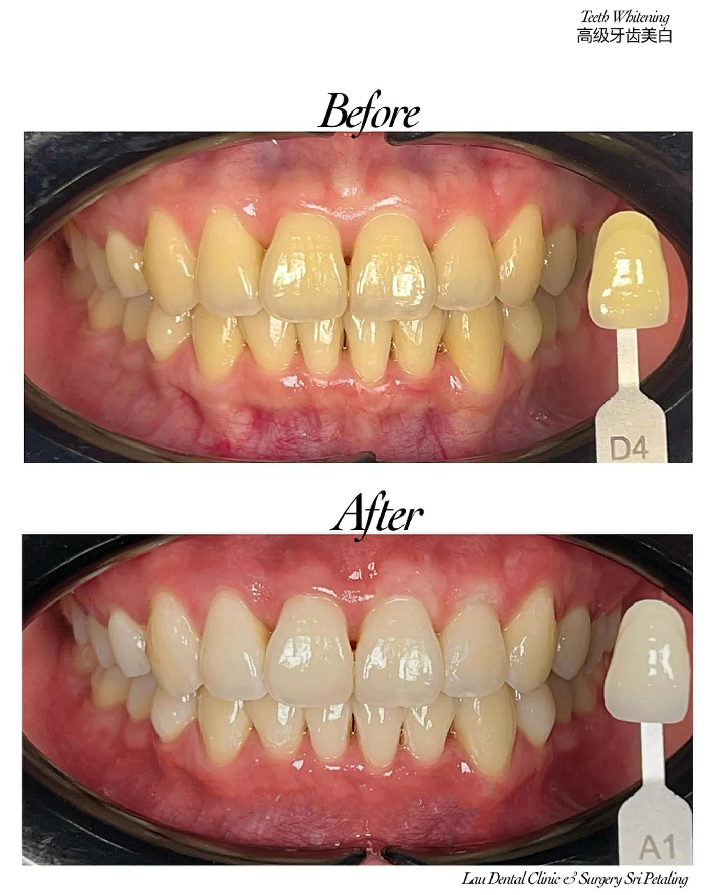 Teeth whitening before and after on noticeably yellow teeth, lifting the shade from D4 to A1 without damaging enamel