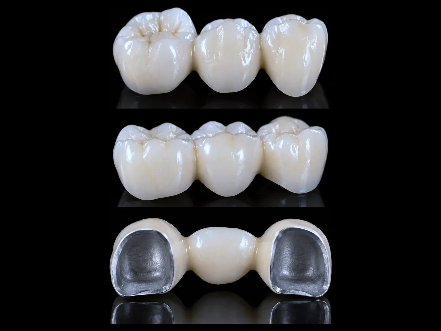 Types of dental bridges — zirconia, porcelain and metal-ceramic three-unit bridges that replace a missing tooth and restore your bite