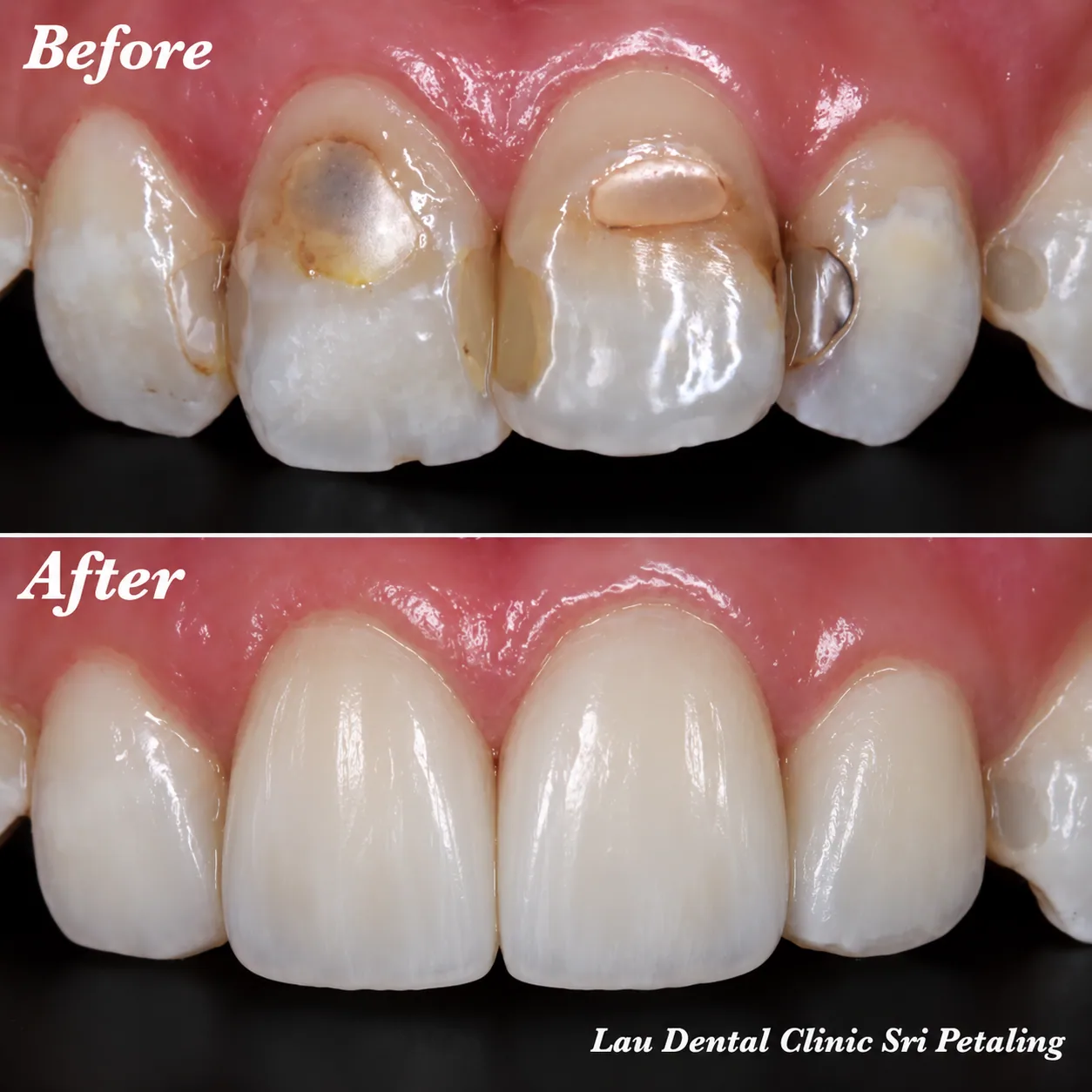 Close-up veneers before and after, covering stained, failing fillings on the upper front teeth with smooth, even and natural-looking restorations