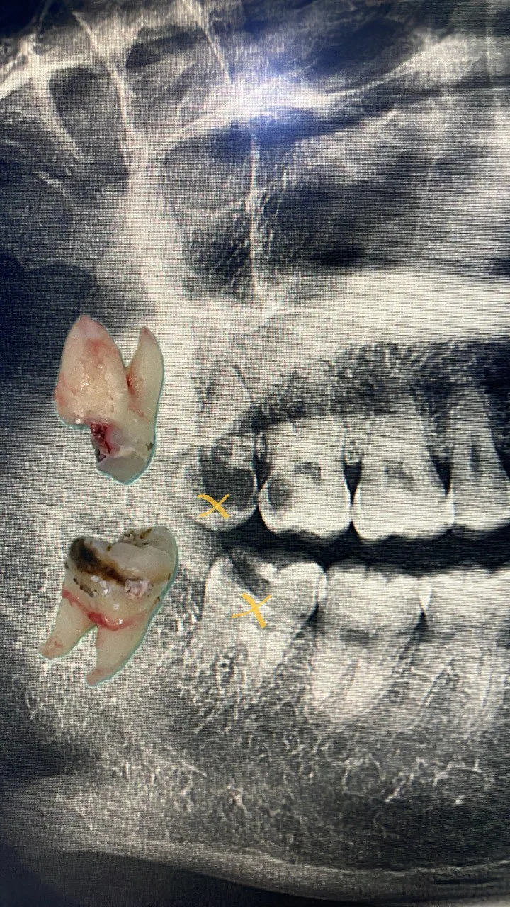 Panoramic dental X-ray taken in-house before surgery, with the two problem wisdom teeth marked and later removed
