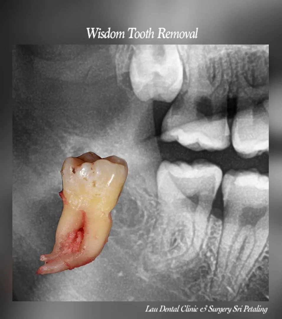 Extracted wisdom tooth with long curved roots beside the X-ray taken before surgery, planned in advance for a smoother recovery